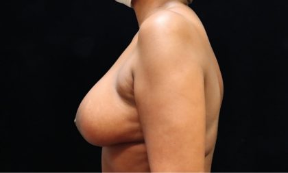 Breast Augmentation Before & After Patient #11505