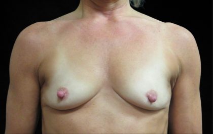 Breast Augmentation Before & After Patient #11508
