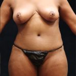 Mommy Makeover Before & After Patient #11510