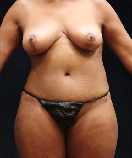 Mommy Makeover Before & After Patient #11510