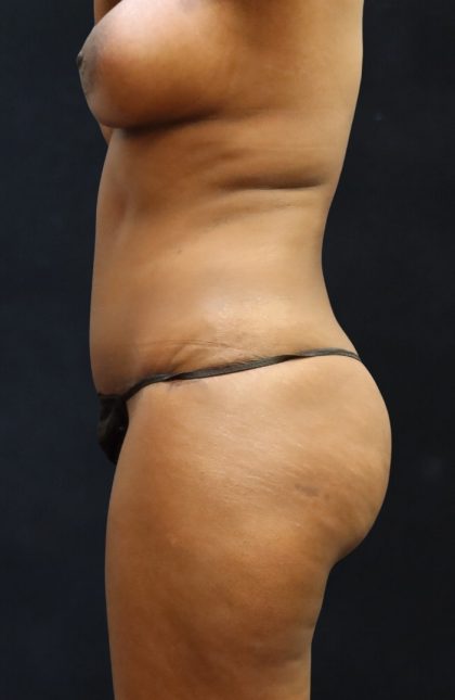 Mommy Makeover Before & After Patient #11511