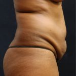 Mommy Makeover Before & After Patient #11511