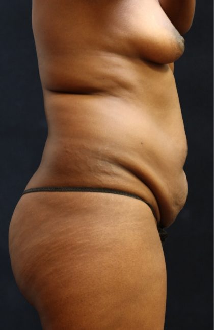 Mommy Makeover Before & After Patient #11511