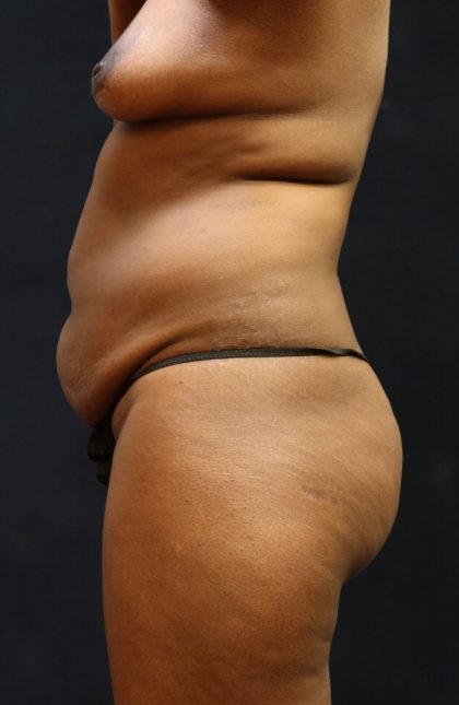 Mommy Makeover Before & After Patient #11511