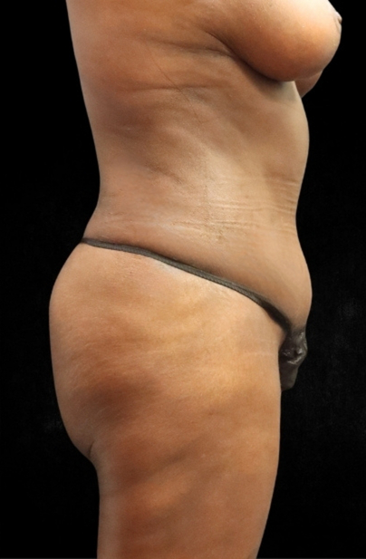 Post Weight Loss Before & After Patient #11512