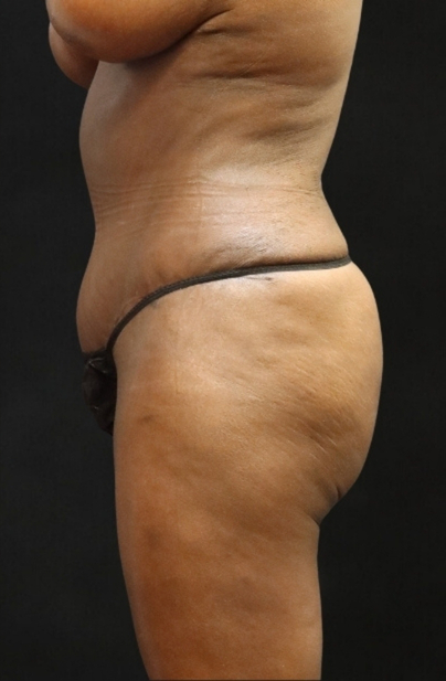 Post Weight Loss Before & After Patient #11512
