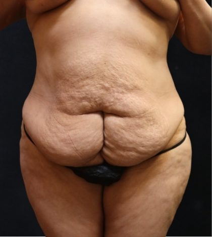 Post Weight Loss Before & After Patient #11513