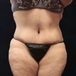 Post Weight Loss Before & After Patient #11513