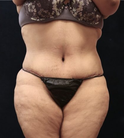 Post Weight Loss Before & After Patient #11513