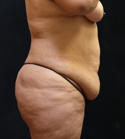 Post Weight Loss Before & After Patient #11513
