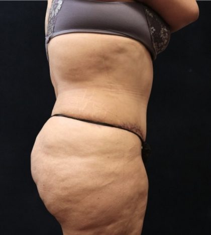 Post Weight Loss Before & After Patient #11513