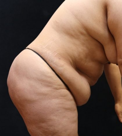 Post Weight Loss Before & After Patient #11513