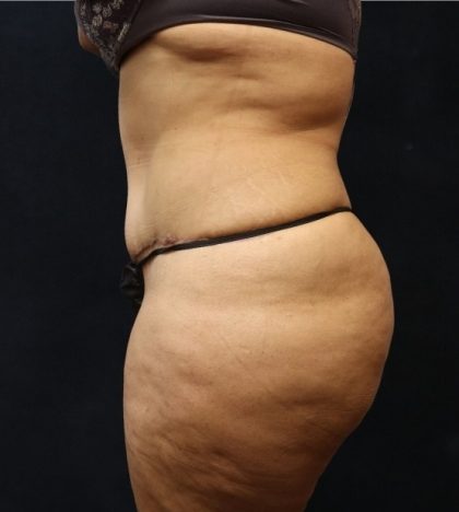 Post Weight Loss Before & After Patient #11513
