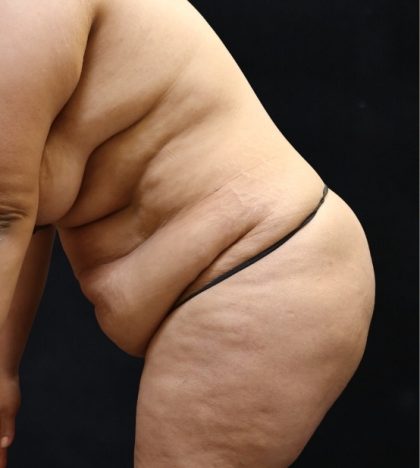 Post Weight Loss Before & After Patient #11513