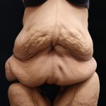 Post Weight Loss Before & After Patient #11514
