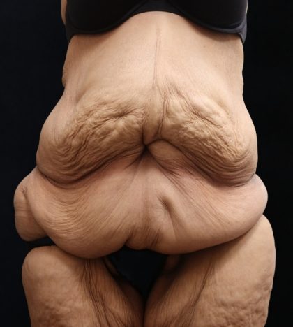Post Weight Loss Before & After Patient #11514