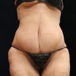 Post Weight Loss Before & After Patient #11514