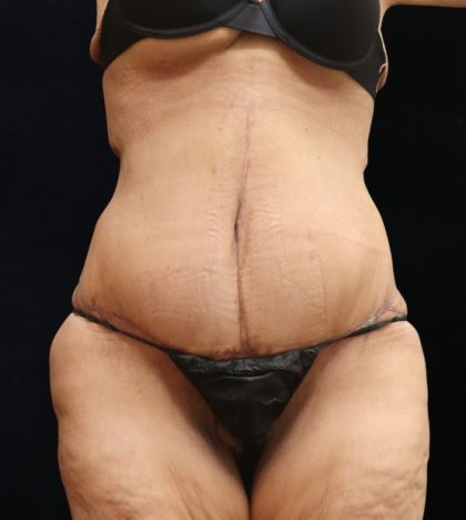 Post Weight Loss Before & After Patient #11514