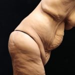 Post Weight Loss Before & After Patient #11514