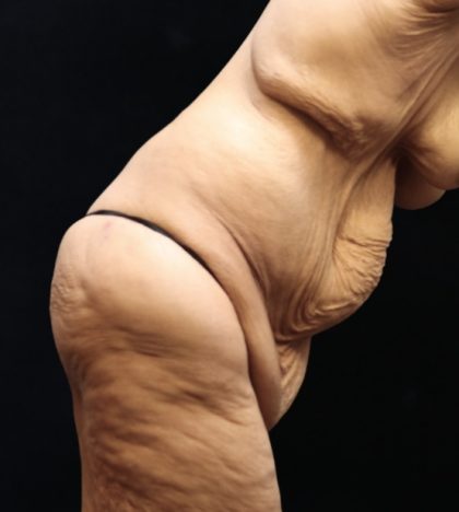Post Weight Loss Before & After Patient #11514