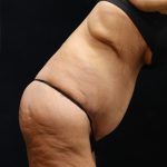 Post Weight Loss Before & After Patient #11514