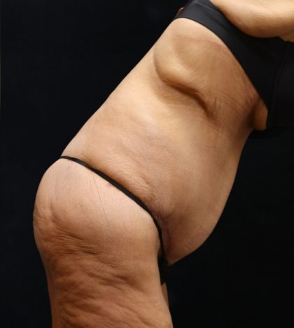 Post Weight Loss Before & After Patient #11514