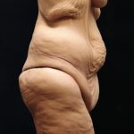 Post Weight Loss Before & After Patient #11514