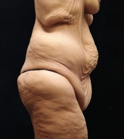 Post Weight Loss Before & After Patient #11514