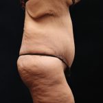 Post Weight Loss Before & After Patient #11514