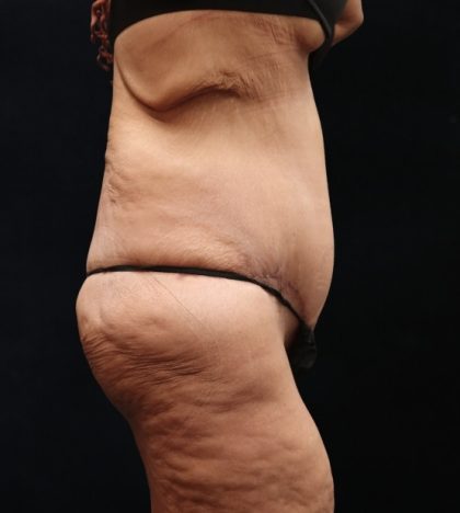 Post Weight Loss Before & After Patient #11514