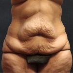 Post Weight Loss Before & After Patient #11515