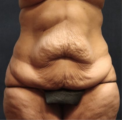 Post Weight Loss Before & After Patient #11515