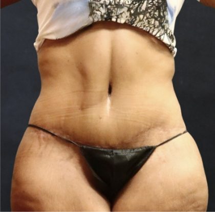 Post Weight Loss Before & After Patient #11515