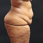 Post Weight Loss Before & After Patient #11515