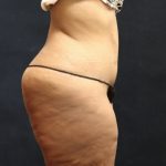Post Weight Loss Before & After Patient #11515