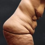 Post Weight Loss Before & After Patient #11515