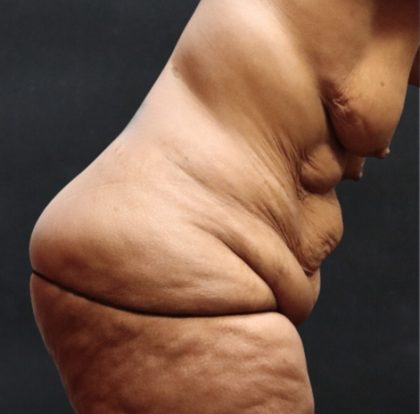 Post Weight Loss Before & After Patient #11515