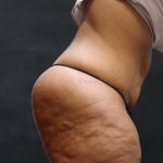 Post Weight Loss Before & After Patient #11515