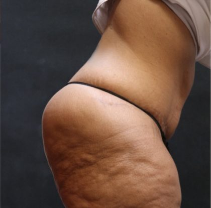 Post Weight Loss Before & After Patient #11515