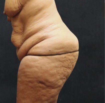 Post Weight Loss Before & After Patient #11515