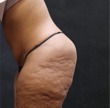 Post Weight Loss Before & After Patient #11515