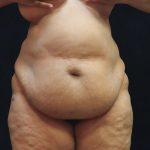 Post Weight Loss Before & After Patient #11516