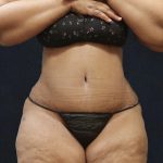 Post Weight Loss Before & After Patient #11516