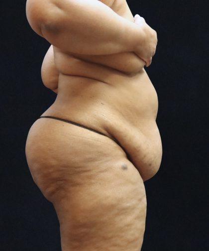 Post Weight Loss Before & After Patient #11516