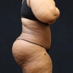 Post Weight Loss Before & After Patient #11516