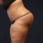 Post Weight Loss Before & After Patient #11516