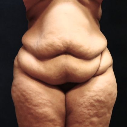 Post Weight Loss Before & After Patient #11517