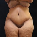 Post Weight Loss Before & After Patient #11517
