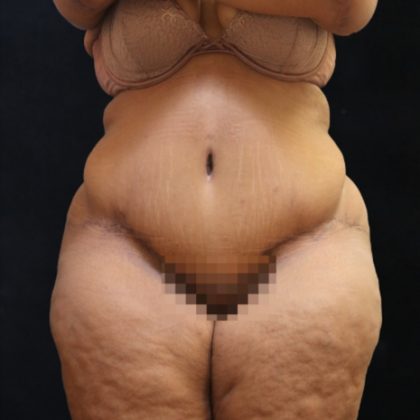 Post Weight Loss Before & After Patient #11517