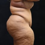 Post Weight Loss Before & After Patient #11517